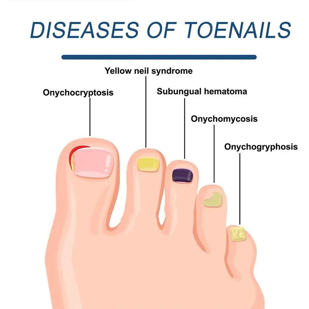 Nail Fungal Treatment